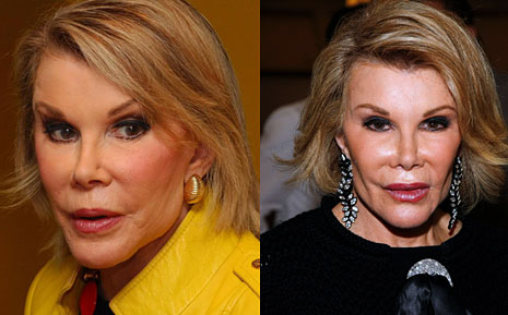 Joan Rivers face