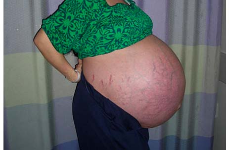 octo-mom pregant belly