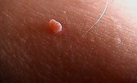 skin tags